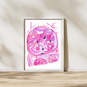 Breast Cancer Histopathology Art - DCIS