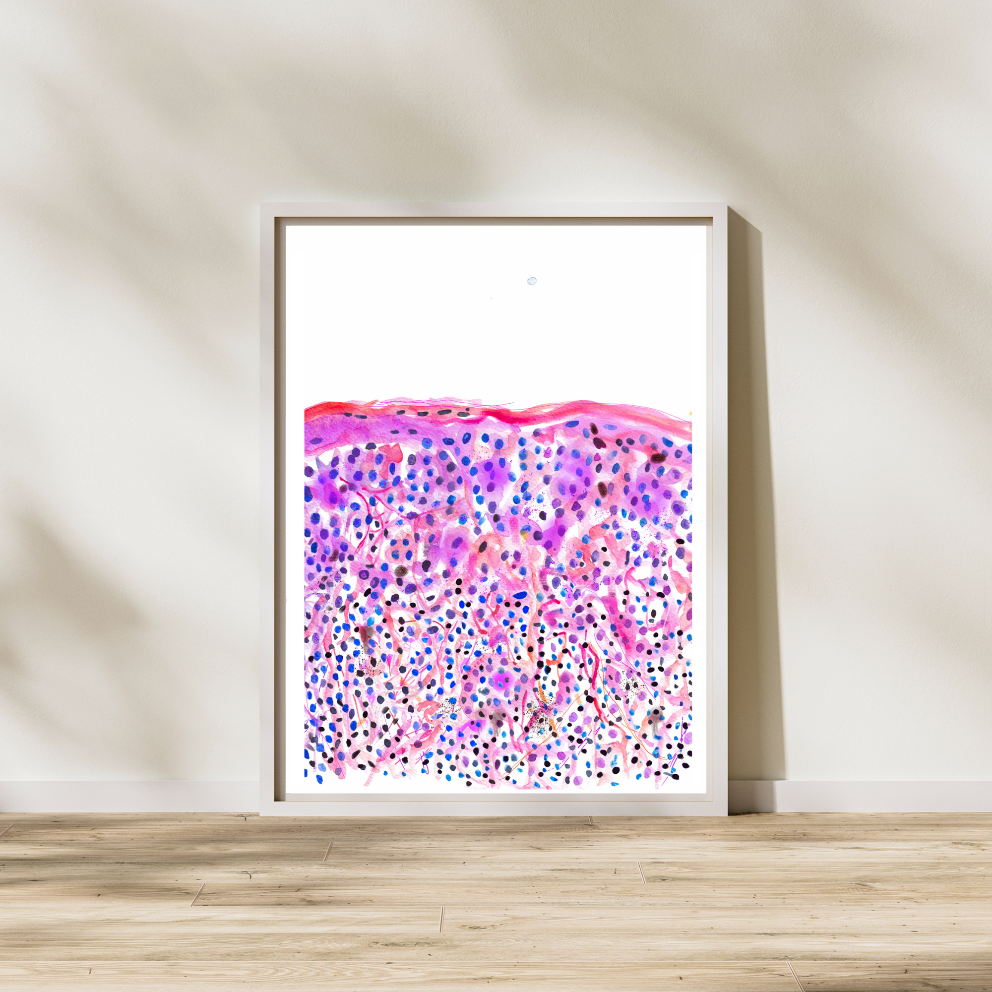 skin cancer watercolor art print