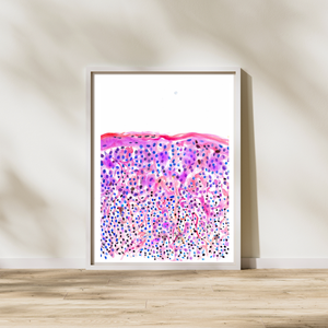 skin cancer watercolor art print