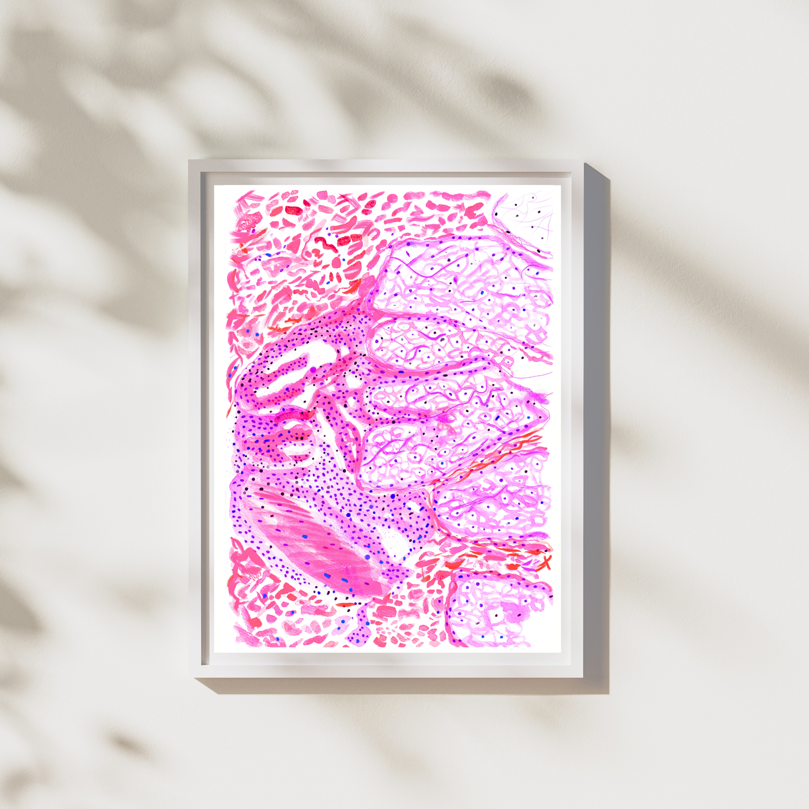 leprosy skin histopathology art