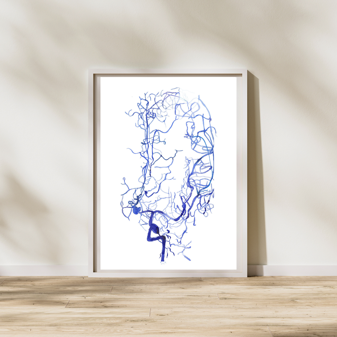 Brain Aneurysm Angiography Art Print
