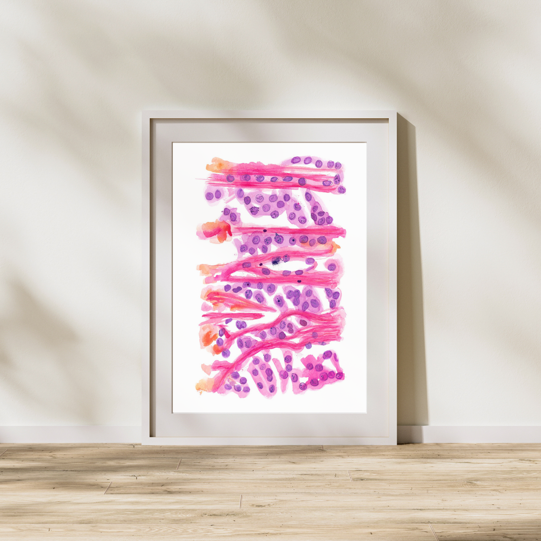 Melanoma Nevus Skin Cancer Histopathology Watercolor Painting