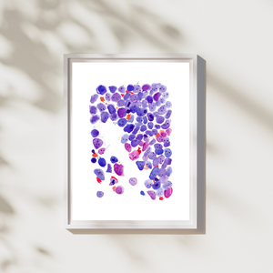 Acute Myeloid Leukemia Art Print