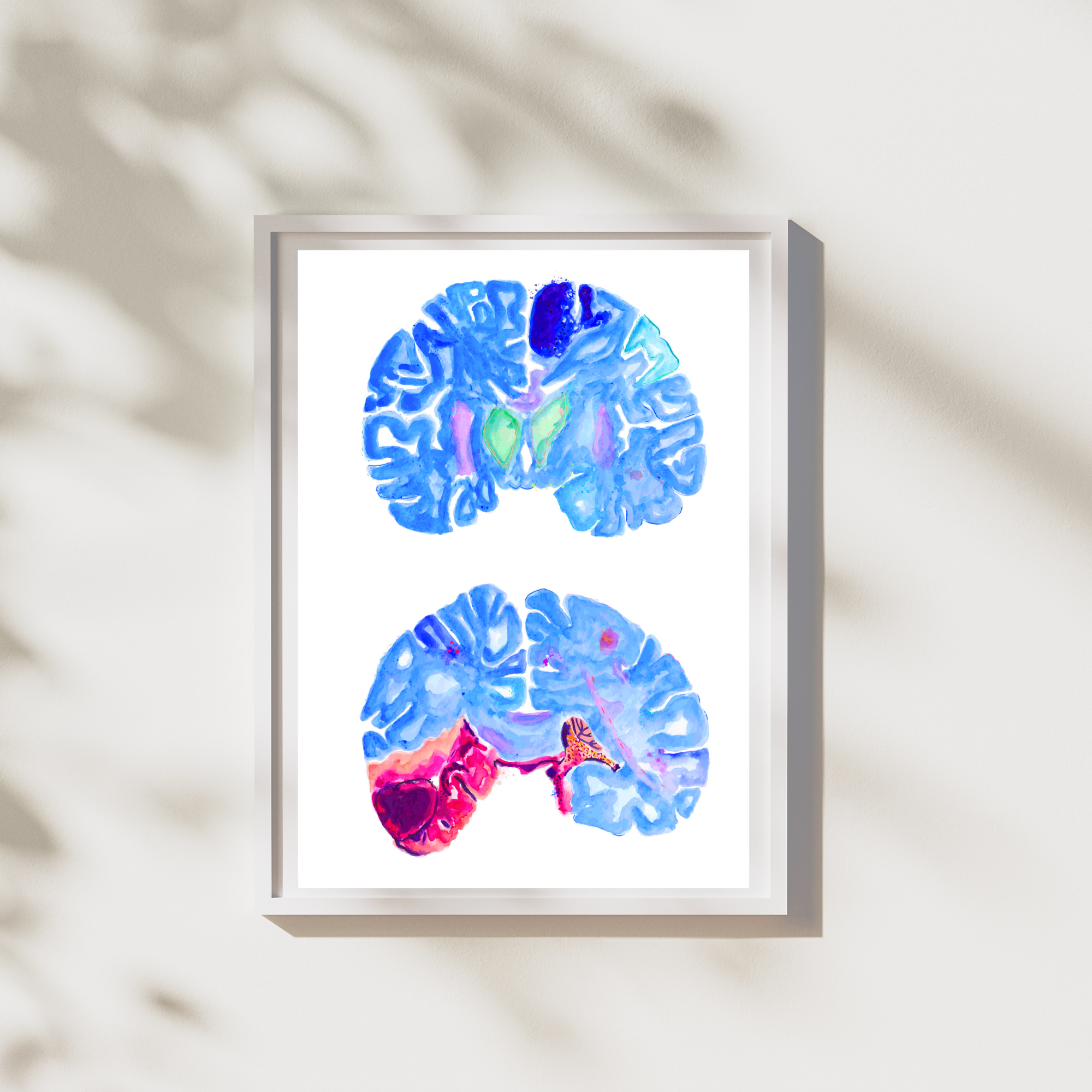 Stroke Art, Pathology Wall Decor, Neurology Print