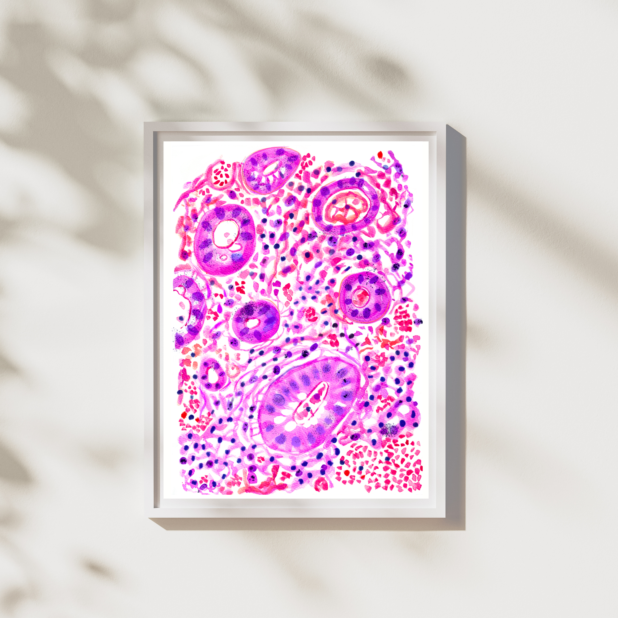 colitis ulcerosa art print