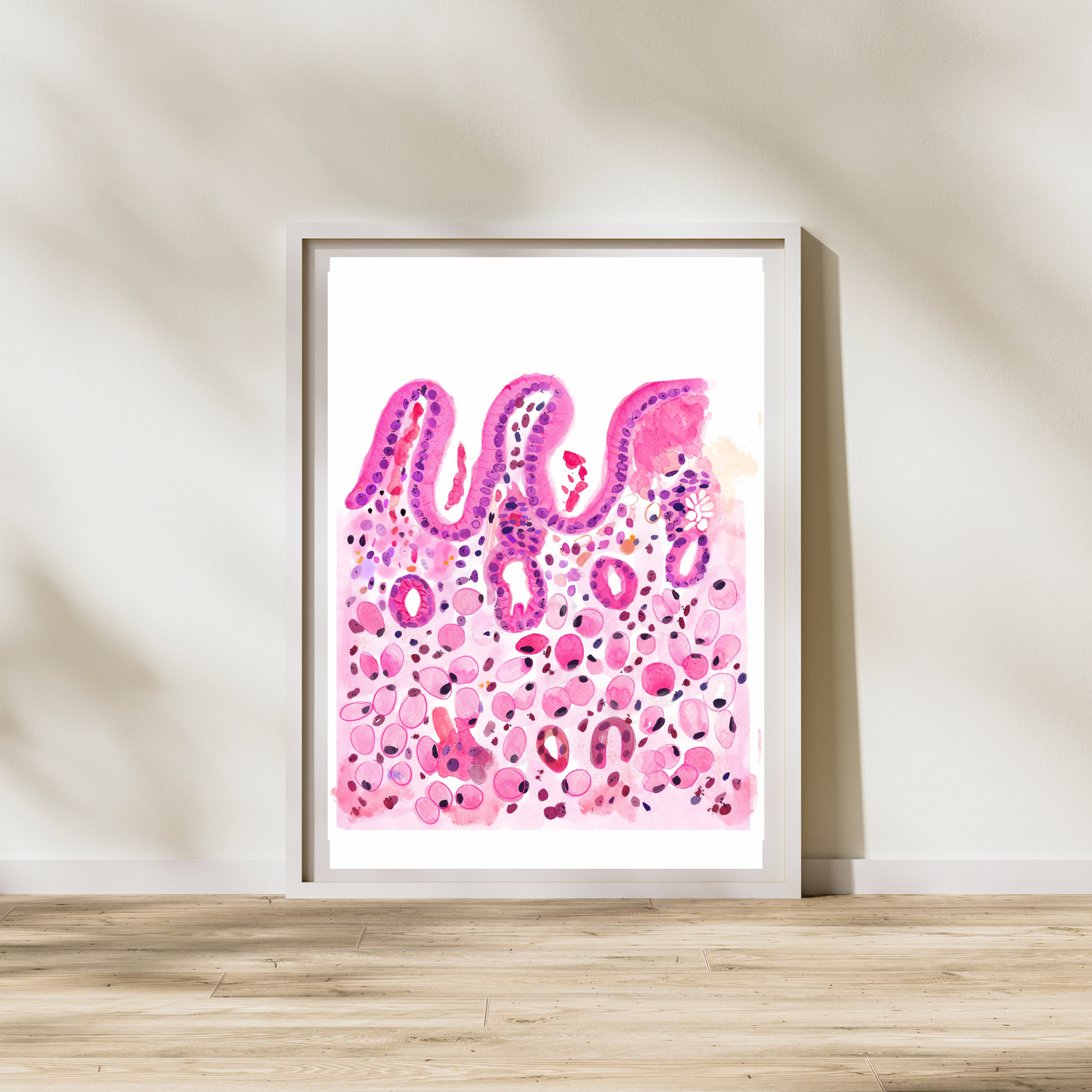 Stomach Signet Ring Carcinoma Histopathology Art