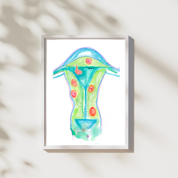 Uterine Fibroids Art Print for OBGYN Offices - medpapers