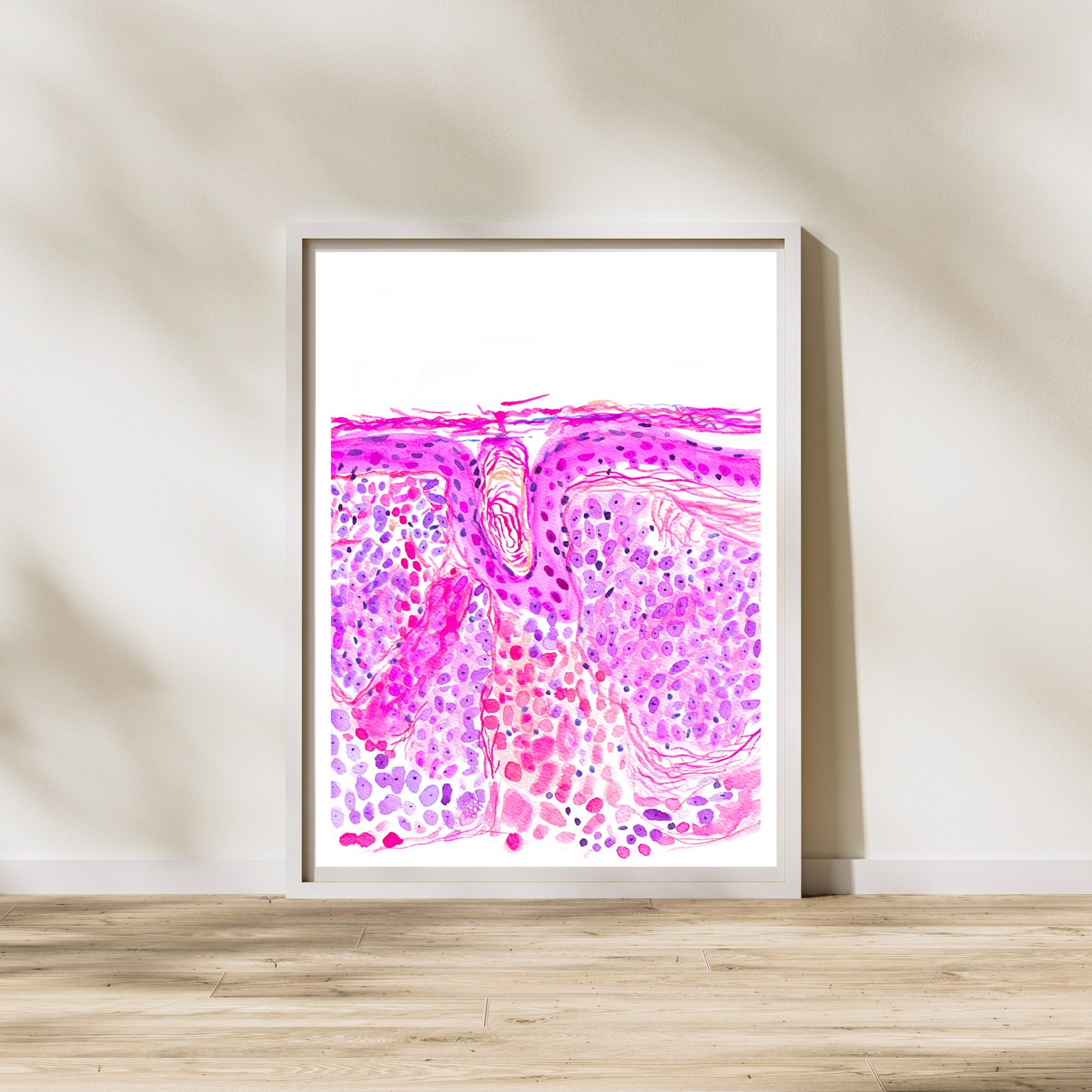 Basal Cell Carcinoma Skin Histopathology Artwork