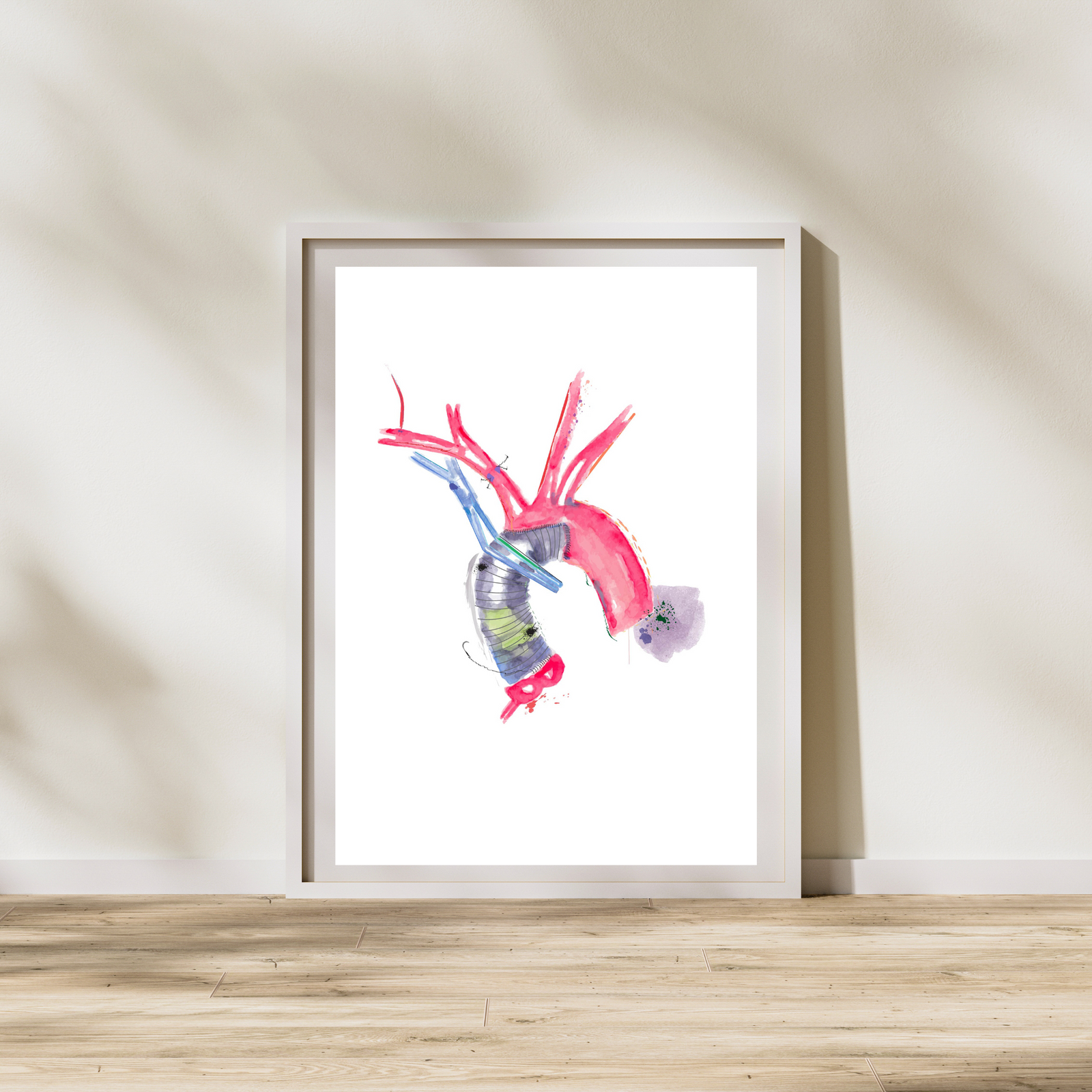 Aorta Aneurysm Repair Art Print