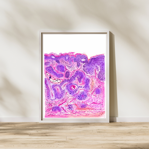 Vulvar Carcinoma Gynecological Pathology Art Print