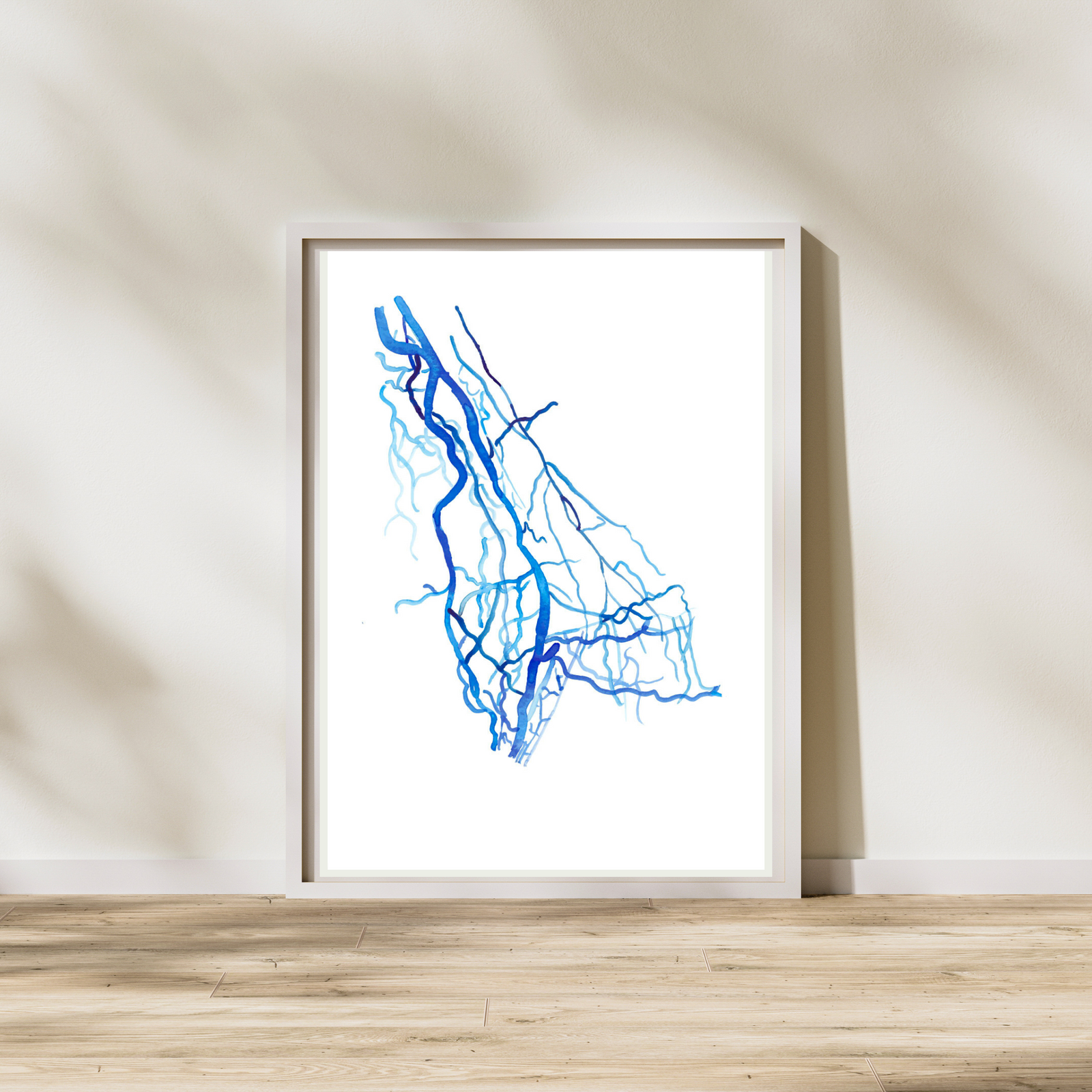 Upper Limb DSA, Vascular Surgery Radiology Art Print