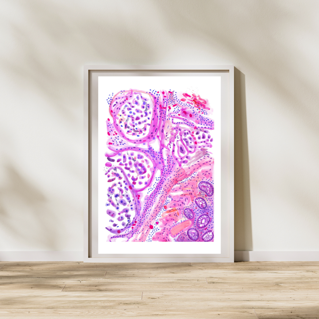 colon adenocarcinoma histopathology painting