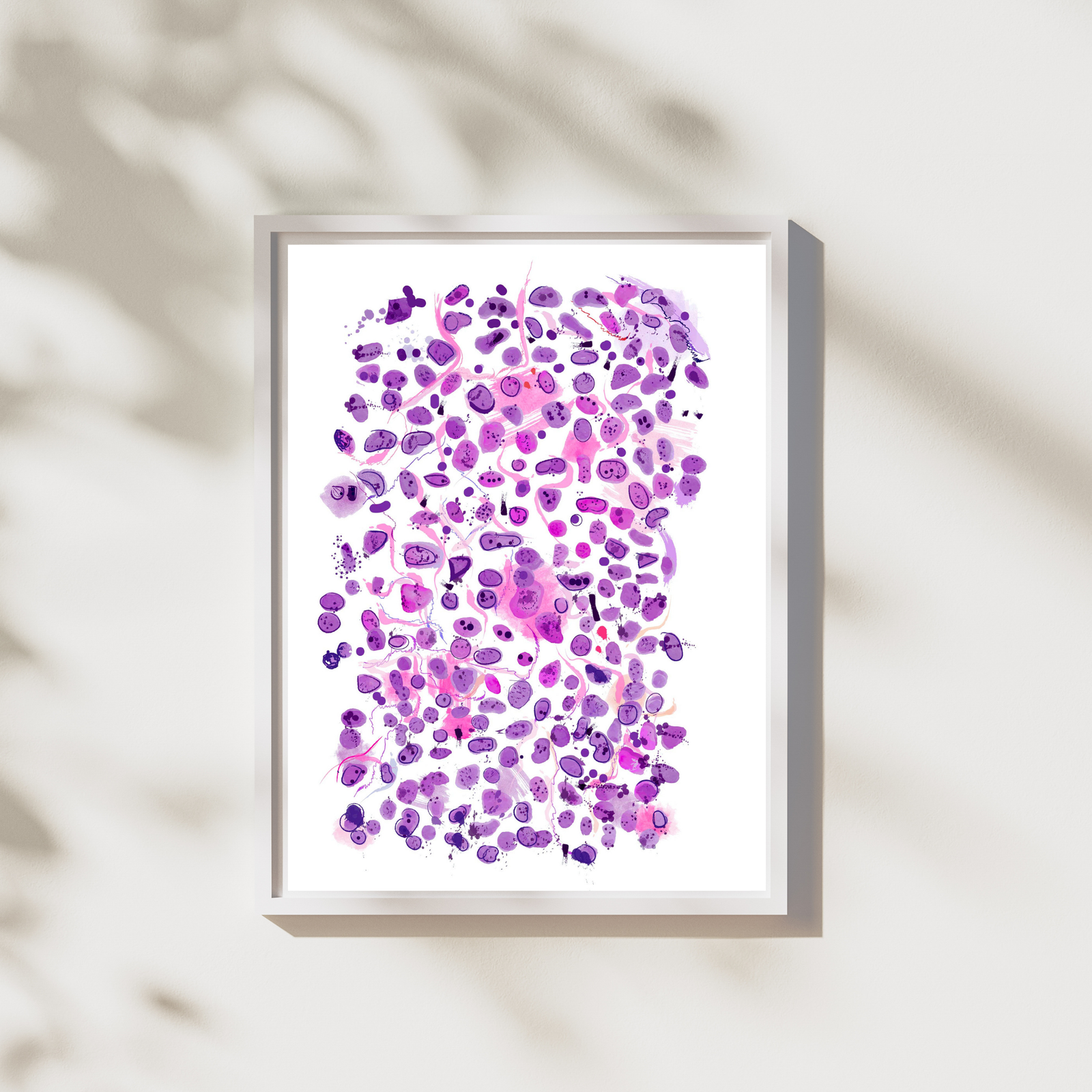 Anaplastic Large Cell Lymphoma Print, Abstract Pathology Art