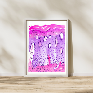 Psoriasis Skin Histopathology Art Print