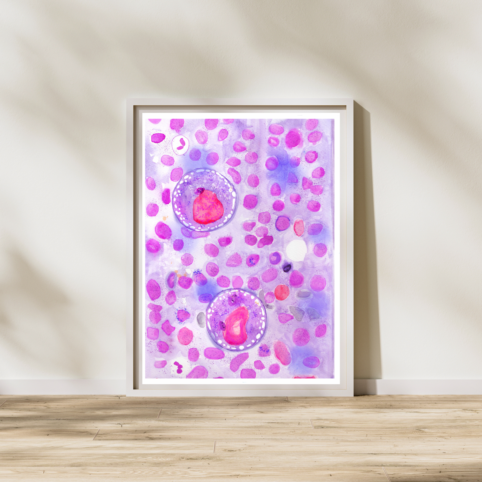 hodgkin lymphoma pathology watercolor art print