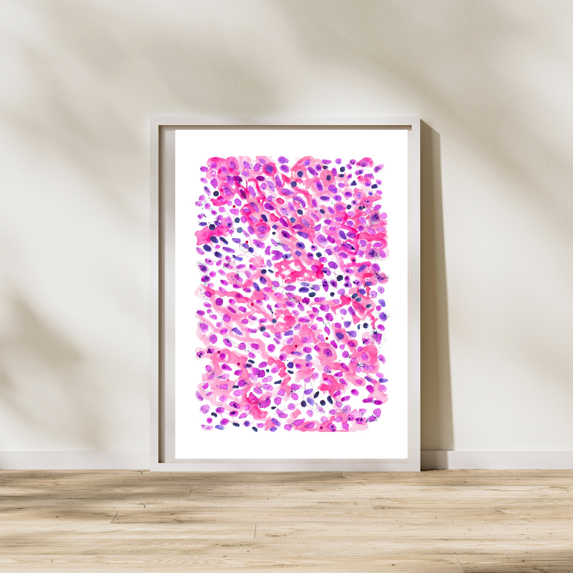 Lung Small Cell Carcinoma Pathology Art Print