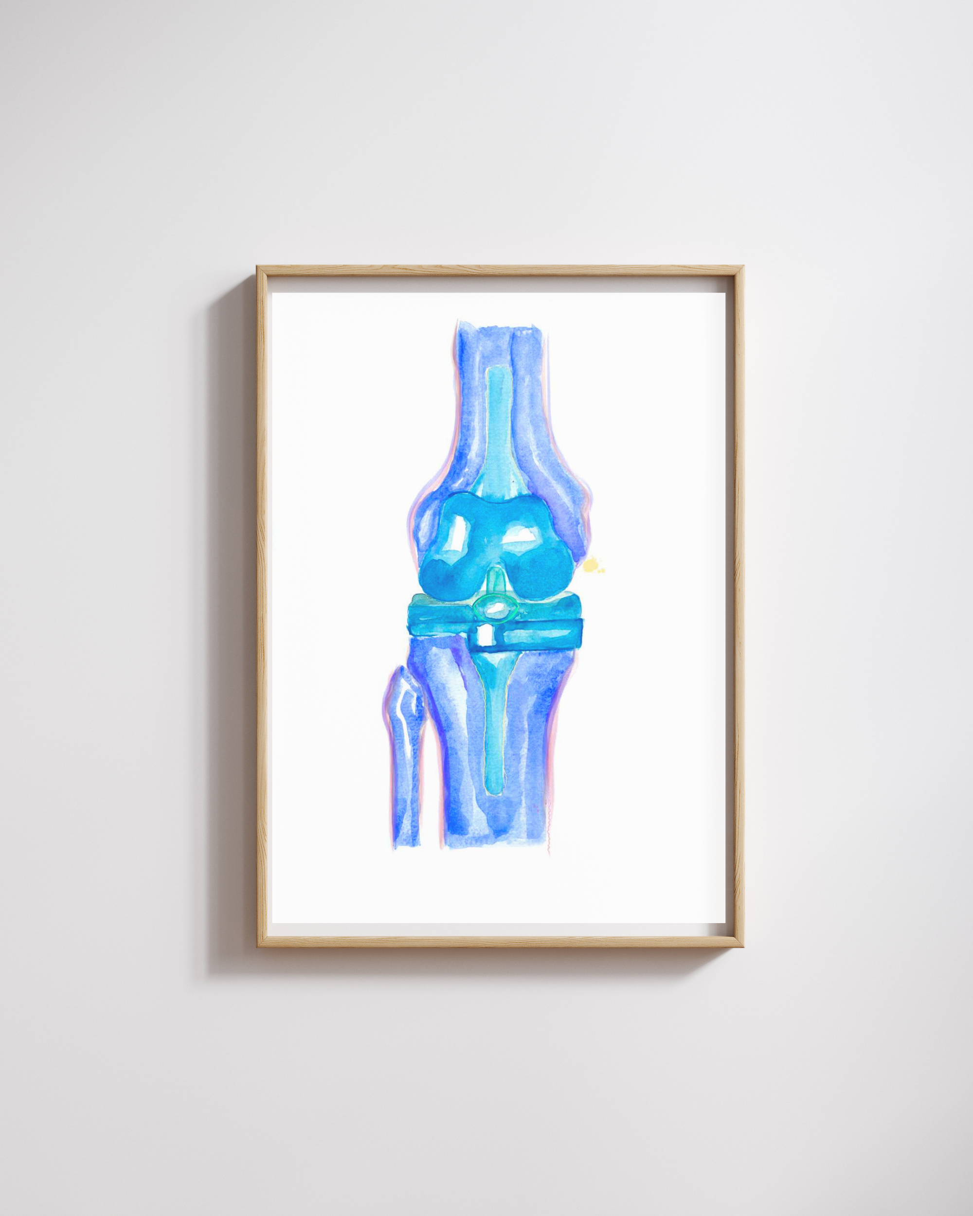 Knee Replacement Orthopedic Surgery Art