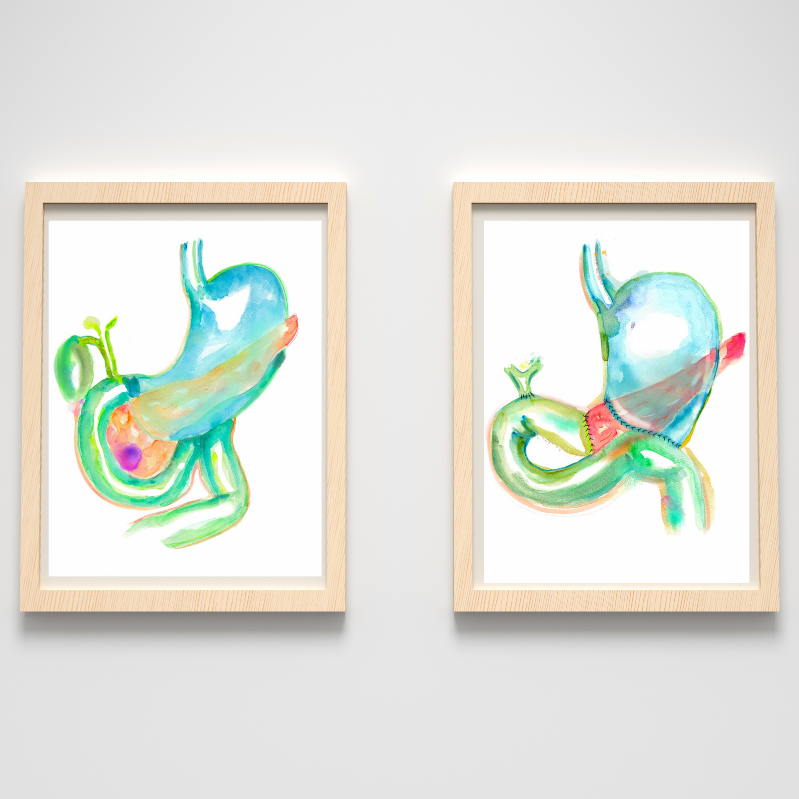 Pancreaticoduodenectomy - Whipple Procedure Art Before and After