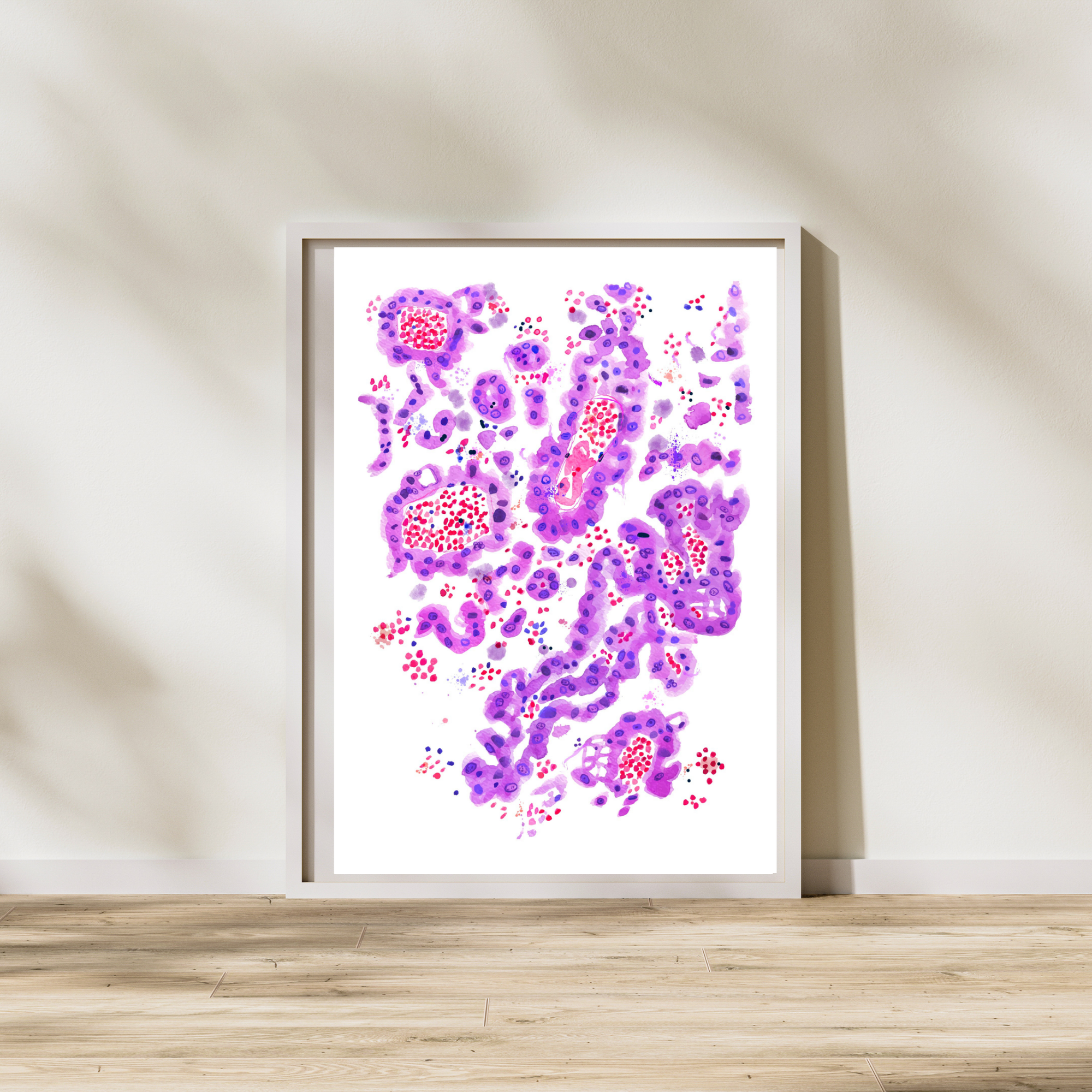 Lung Papillary Adenocarcinoma Pathology Art Print