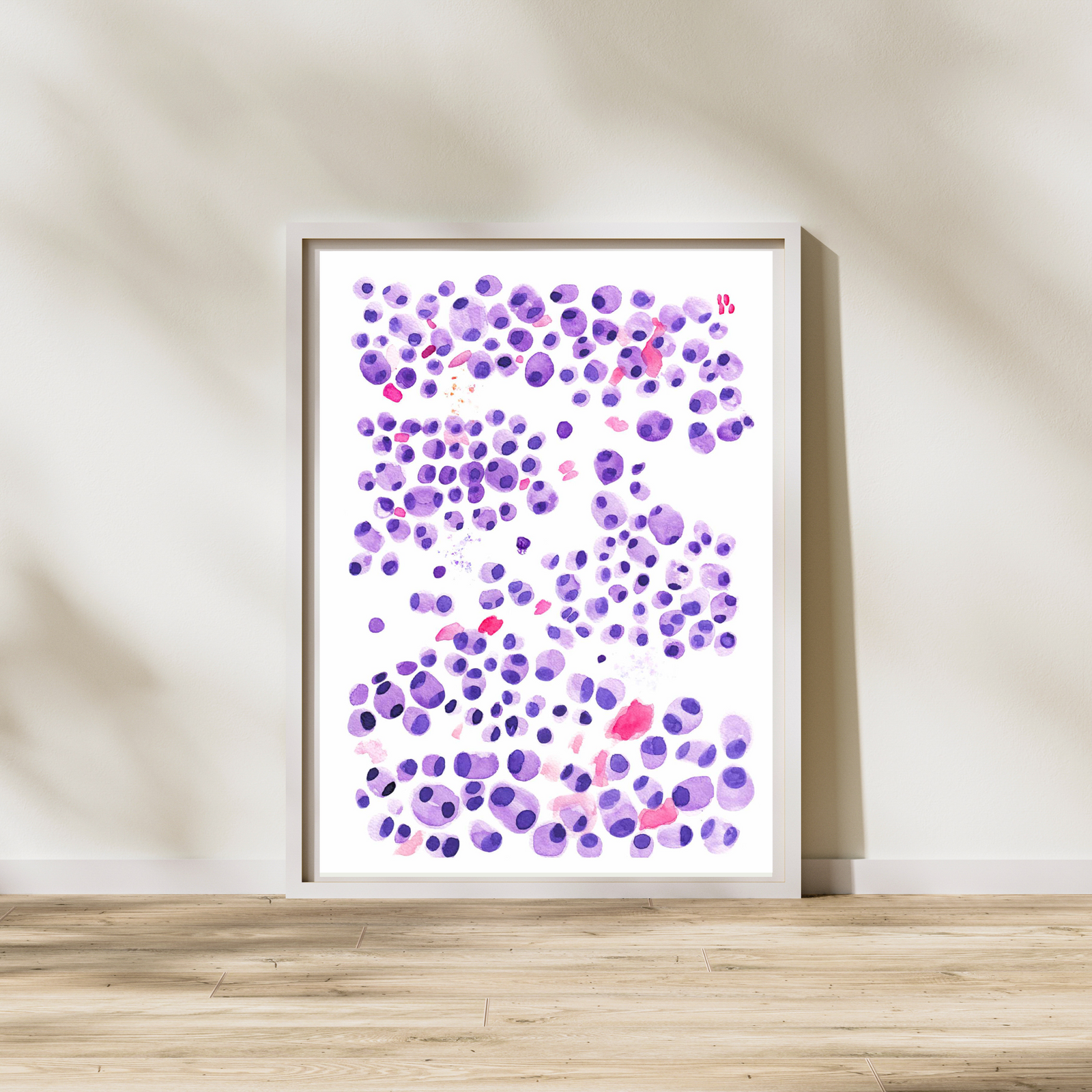 Multiple Myeloma Hematopathology Art