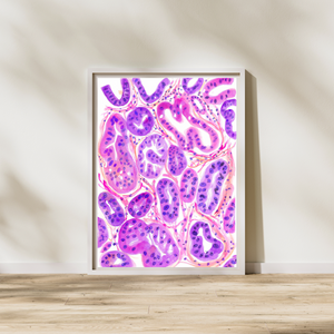 Ovarian Cancer Histopathology Art
