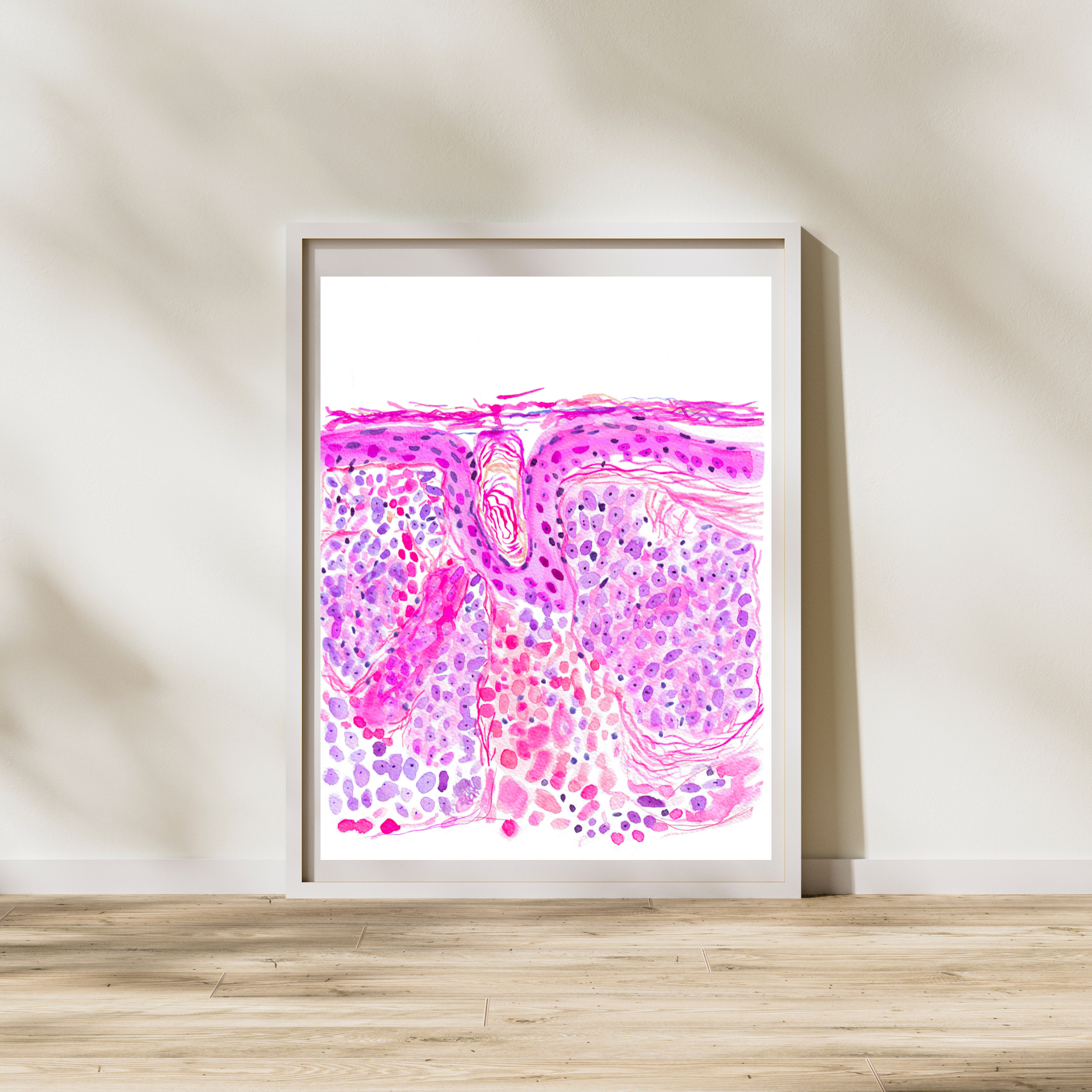 basal cell carinoma skin art print
