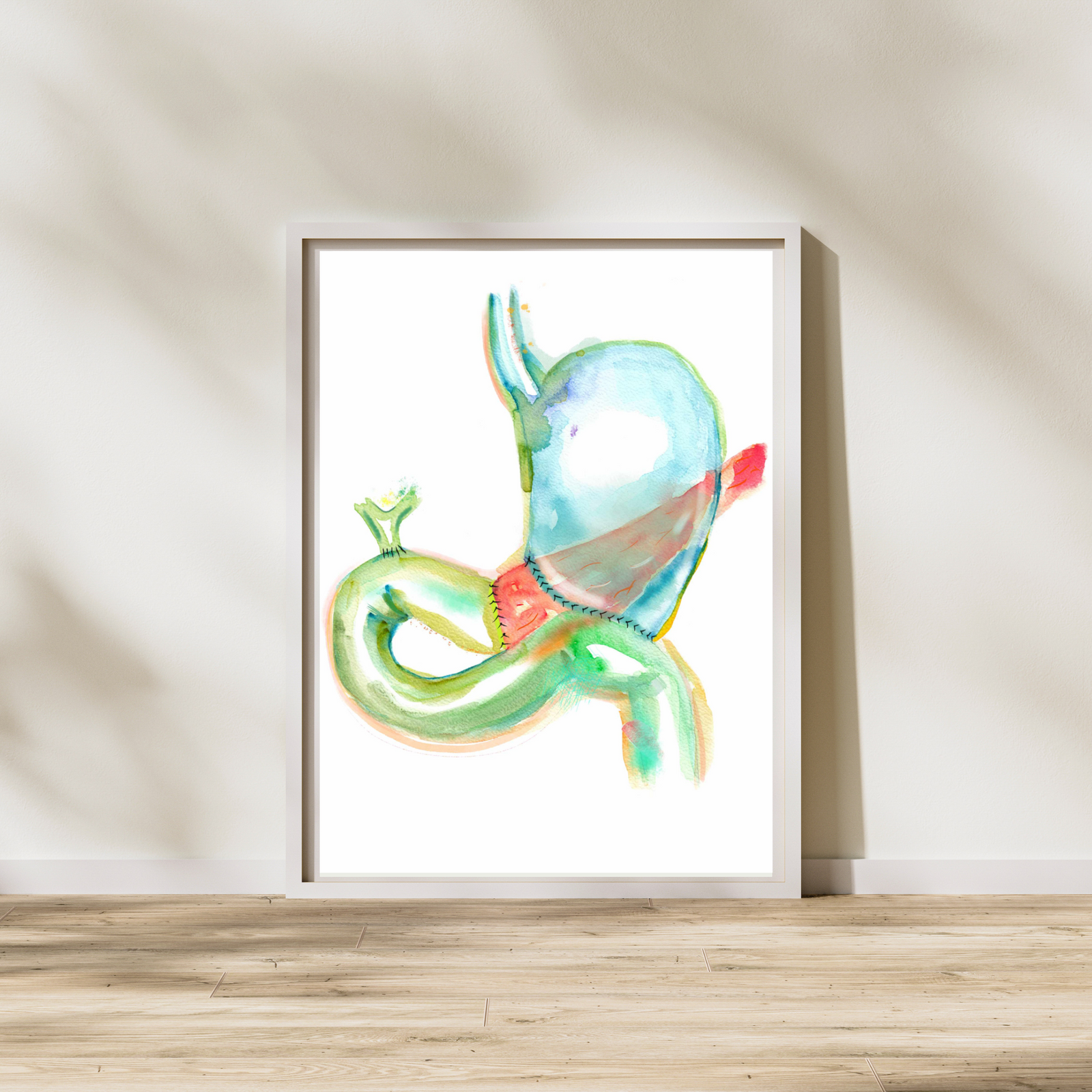 Pancreaticoduodenectomy - Whipple Procedure Art