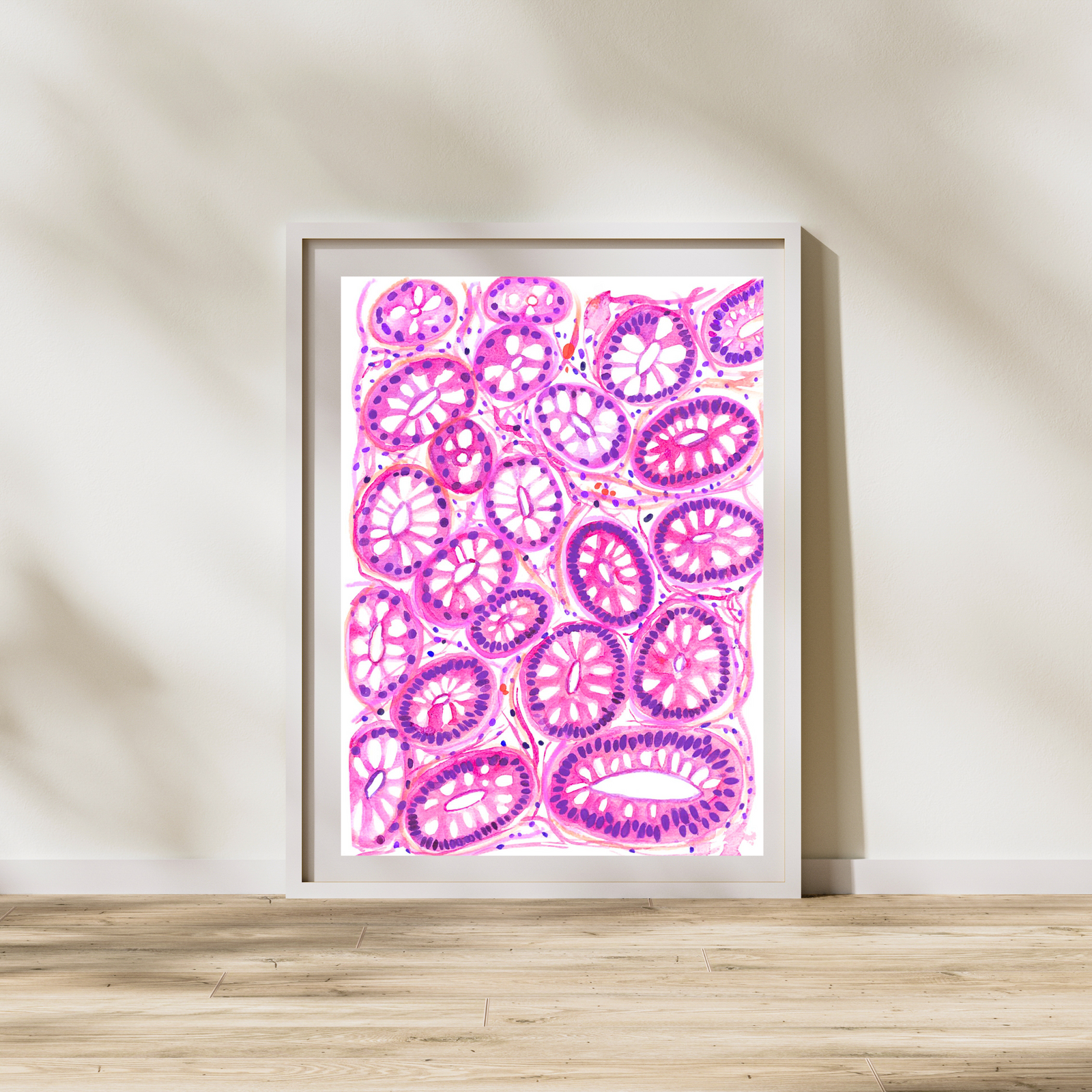 Colon Polyp - Tubular Adenoma Histopathology Art