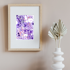 ITP - Idiopathic Thrombocytopenia Bone Marrow Aspirate