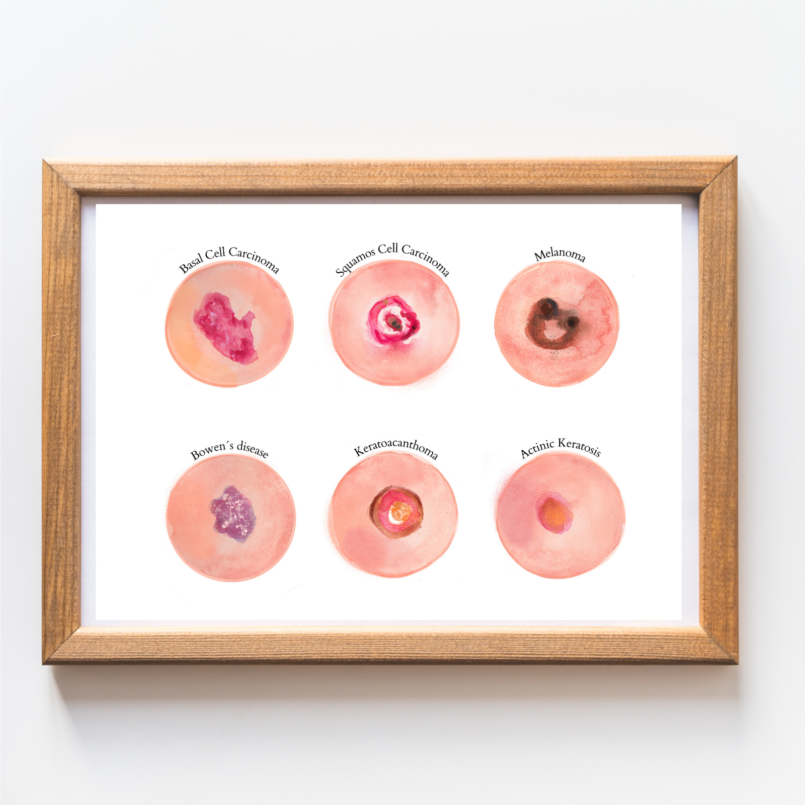 Skin Tumour Watercolor Art