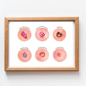 Skin Tumour Watercolor Art