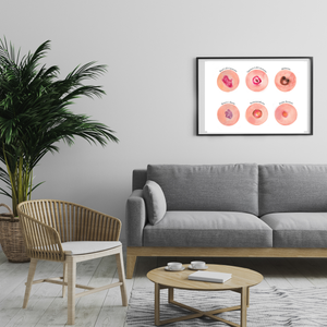 Skin Tumour Watercolor Art