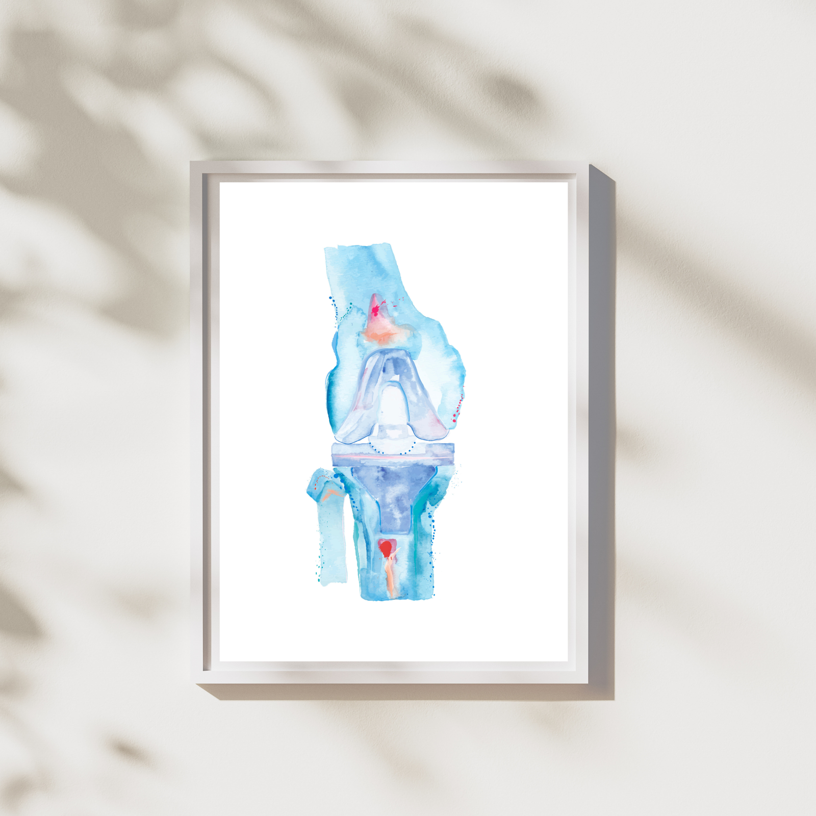 Knee Replacement Surgery Art Print, Orthopedic Surgery Wall Art