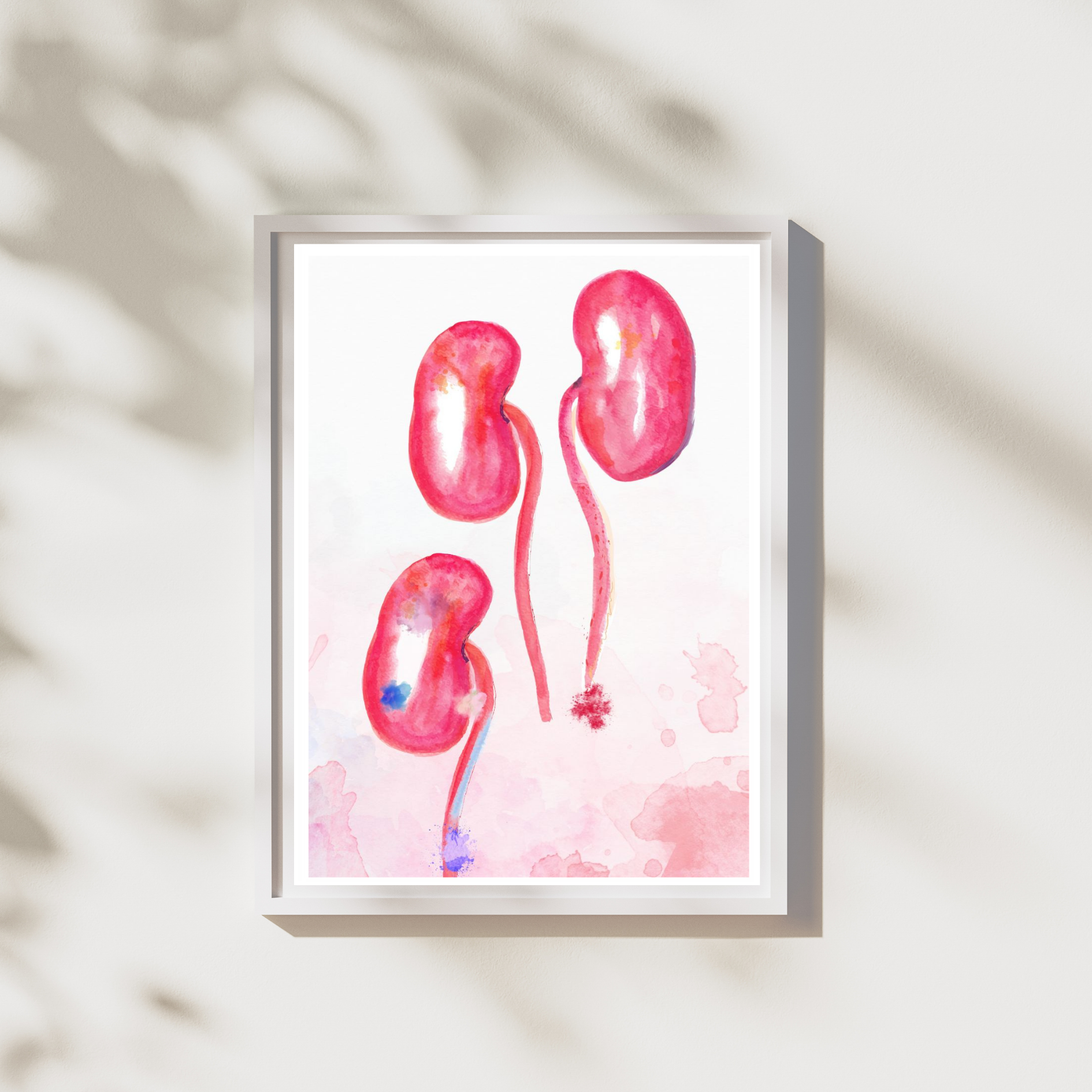 kidney transplant watercolor art print