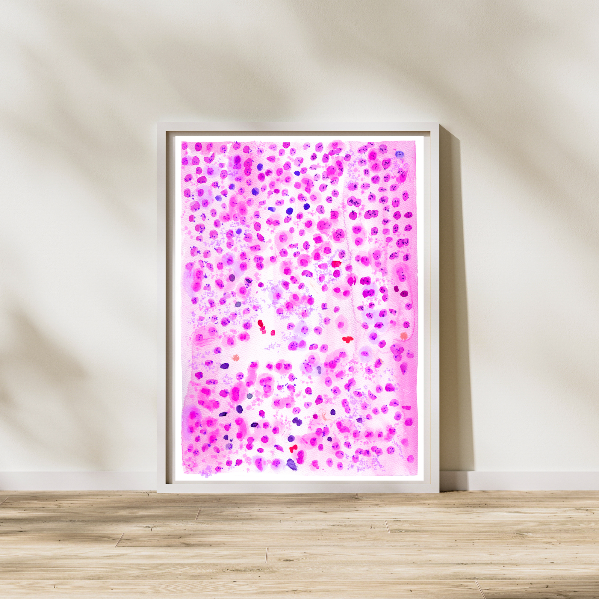 Large B Cell Lymphoma with IRF4 Oncohematology Art Print