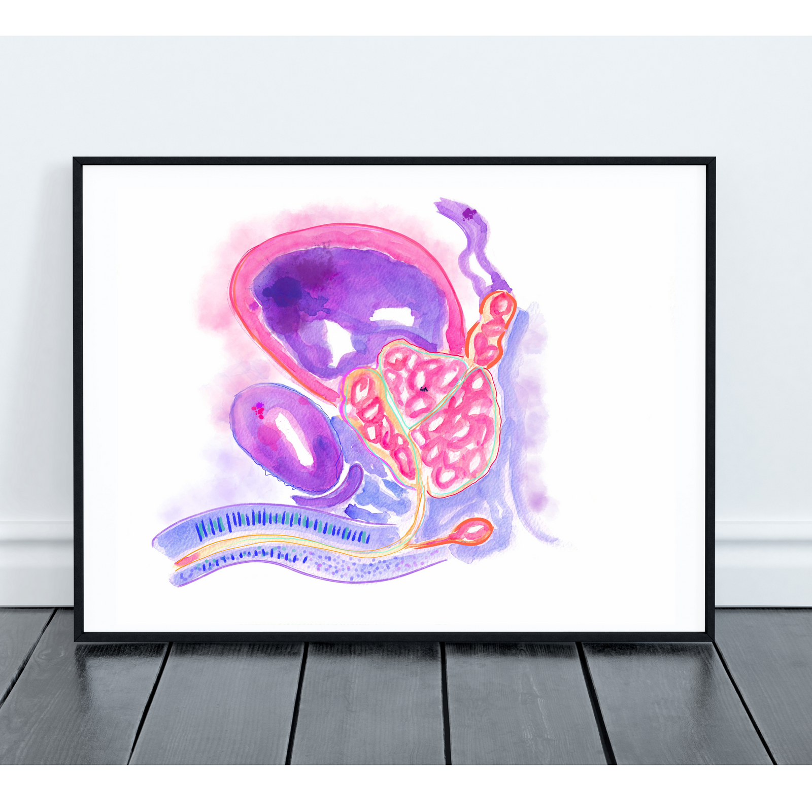 prostate hyperplasia artwork
