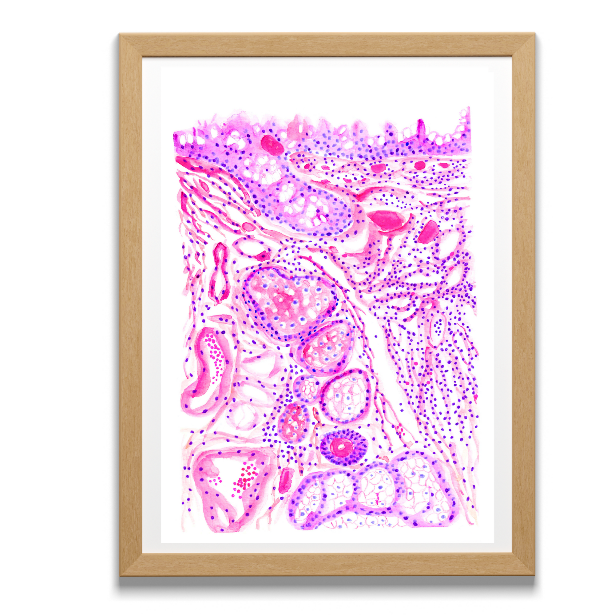 Chronic Conjunctivitis Histopathology Art Print