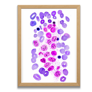 systemic mastocytosis watercolor painting