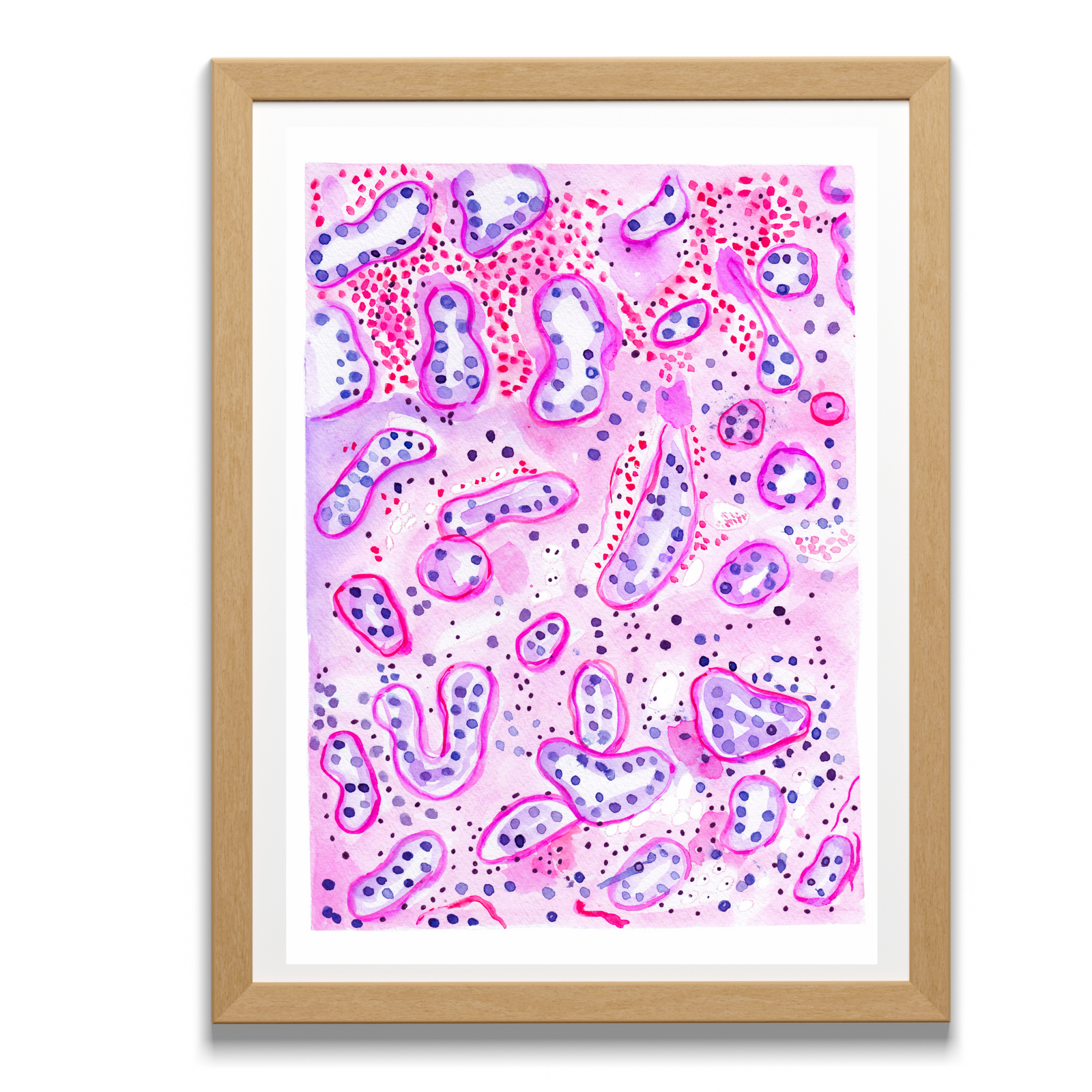 kidney biopsy after transplant with rejection watercolor illustration