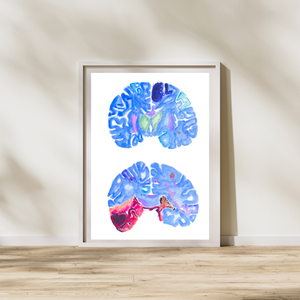 Stroke Art, Pathology Wall Decor, Neurology Print