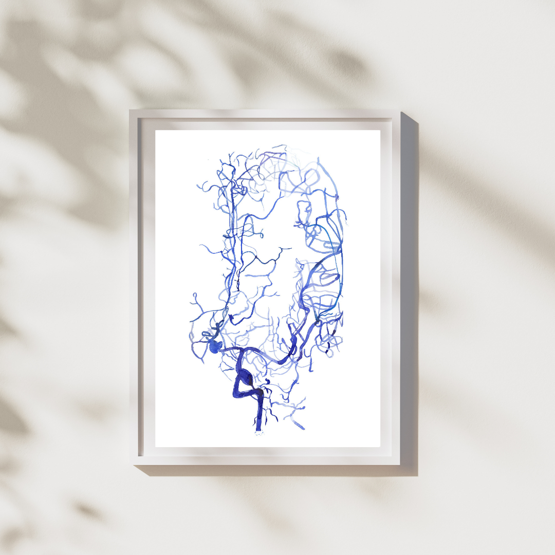 Brain Aneurysm Angiography Art Print