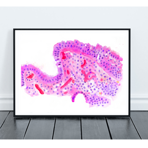 Barrett´s Esophagus Histopathology Art Print