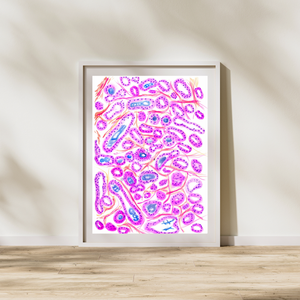 prostate adenocarcinoma watercolor painting