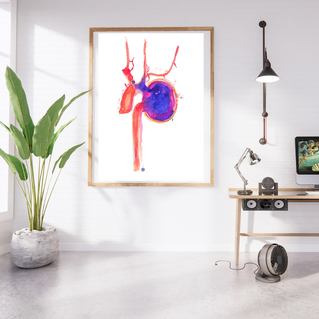 Thoracic Aorta Aneurysm Watercolor Art Print