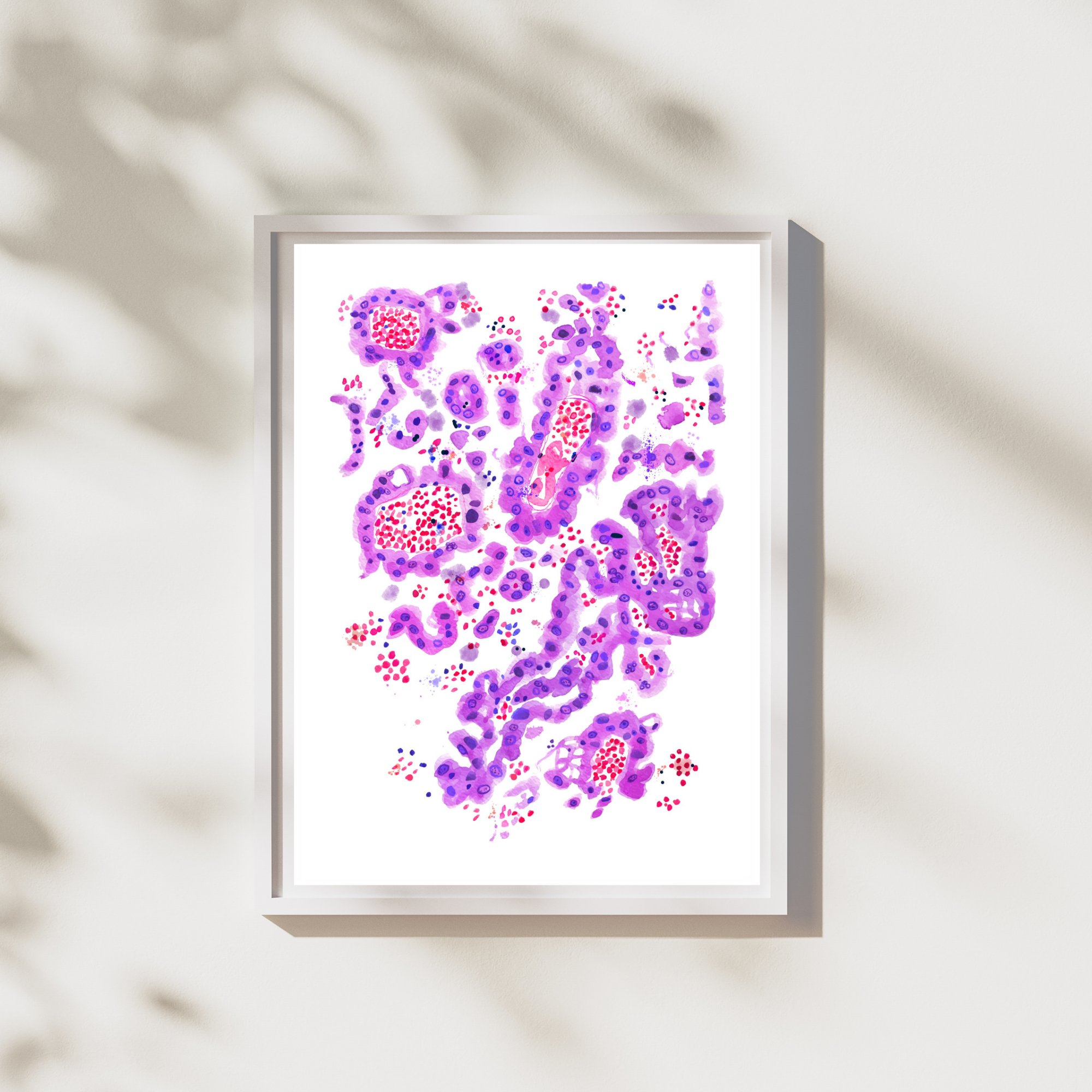 Lung Papillary Adenocarcinoma Pathology Art Print