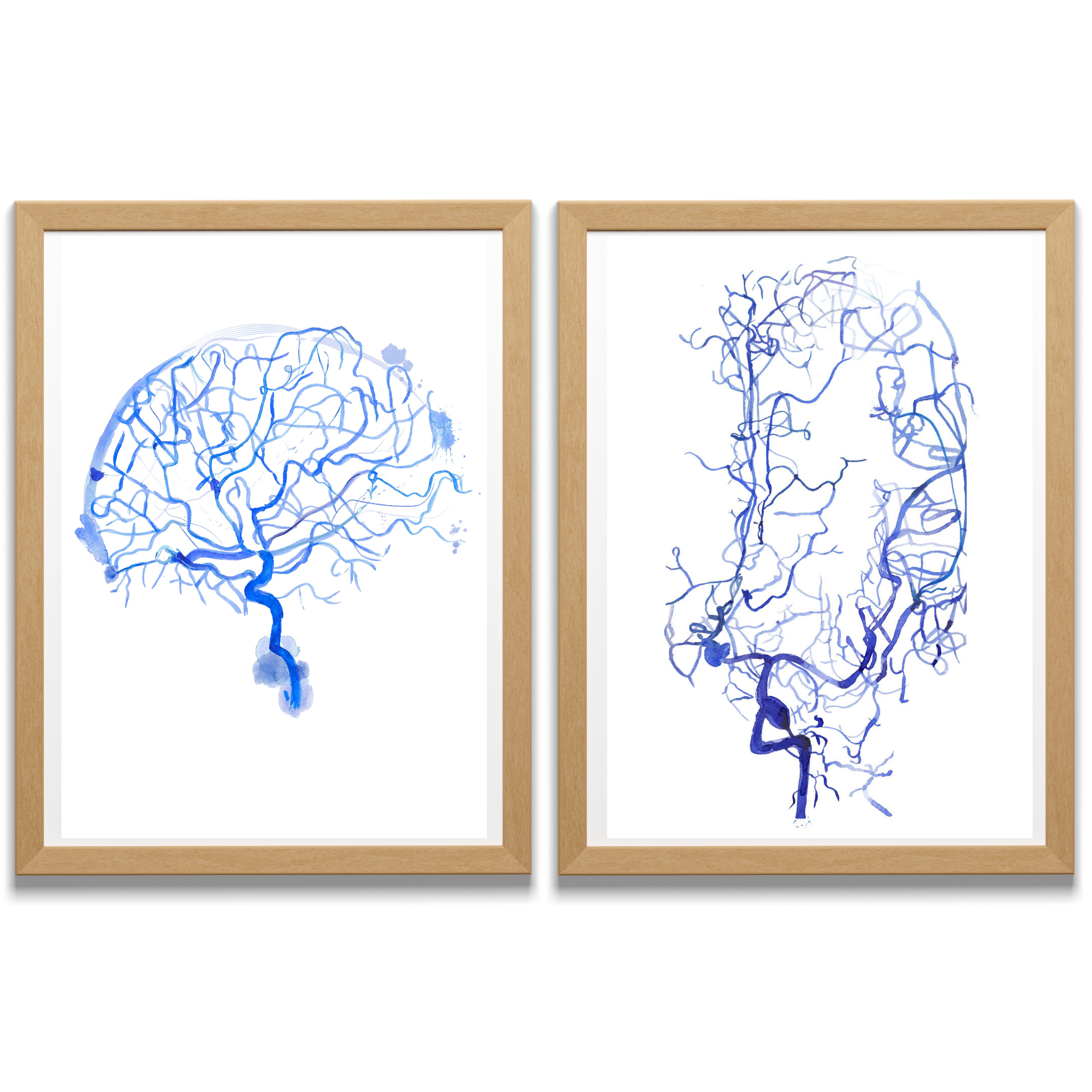 cerebral angiogram brain aneurysm art print
