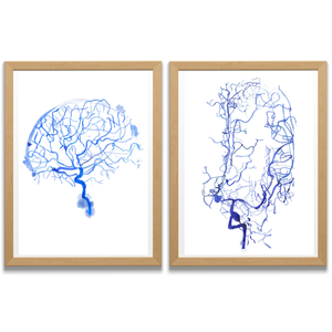 cerebral angiogram brain aneurysm art print
