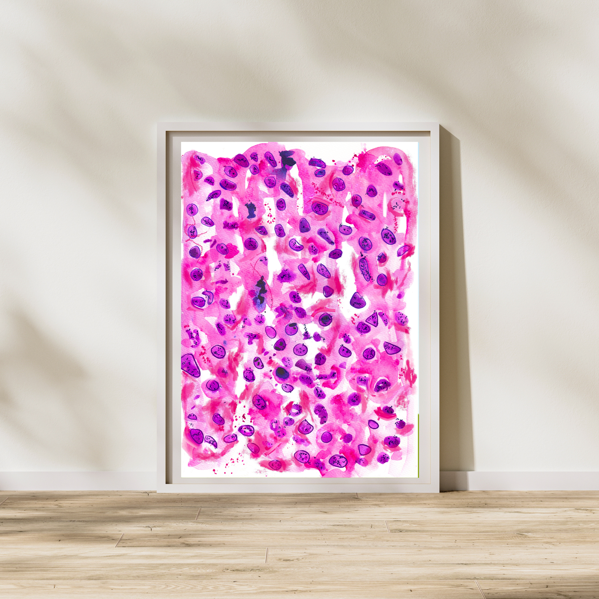 Glioblastoma Neuropathology Watercolor Art Print