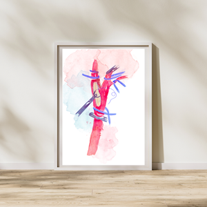 Carotid Endarterectomy with Patch Repair Watercolor Art Print