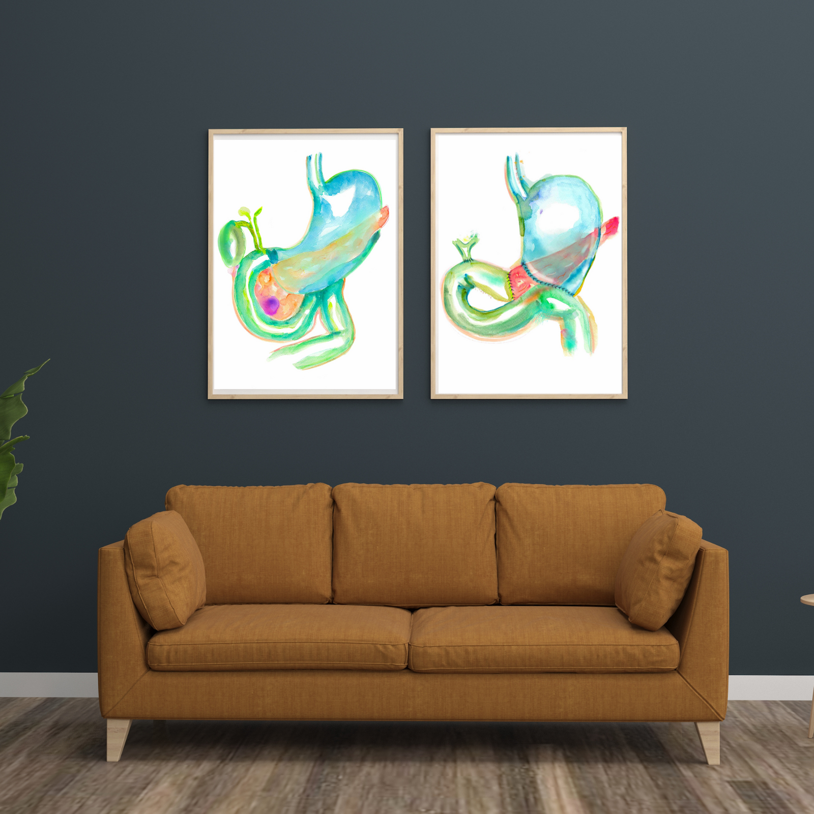 Pancreaticoduodenectomy - Whipple Procedure Art Before and After